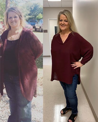 Cynthia B. Before & After Pics Calotren